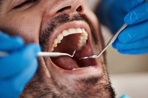 Best Emergency Broken Tooth Repair in Perezville, TX